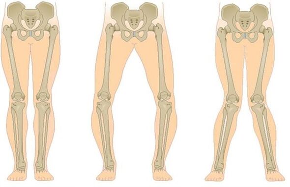 Tipi di osteoartrite