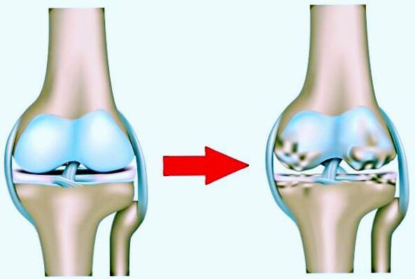 Ginocchio normale e osteoartrosi colpite