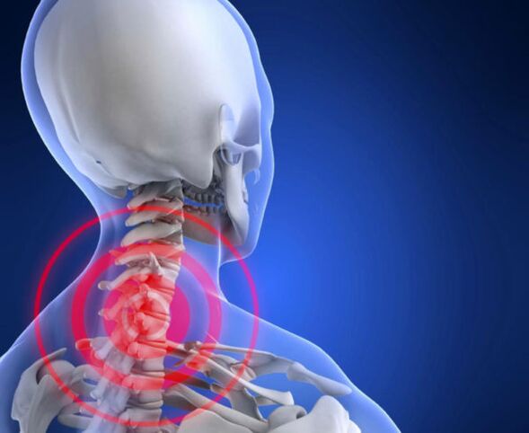Osteocondrosi del rachide cervicale