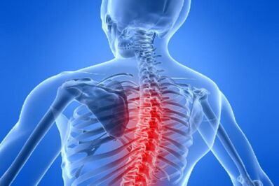 Compressione del midollo spinale nell'osteocondrosi toracica